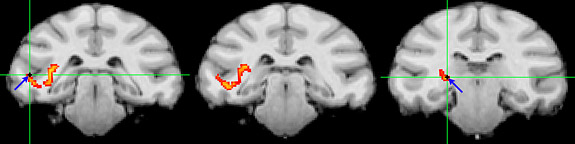 communication paths between the pulvinar and the temporal lobe